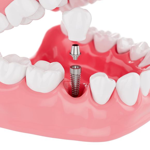 Những lưu ý về việc chăm sóc răng trước và sau khi trồng răng implant